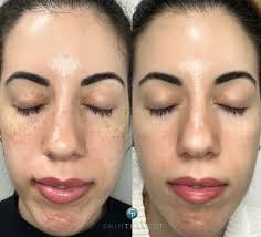Pigmentation Treatment Result